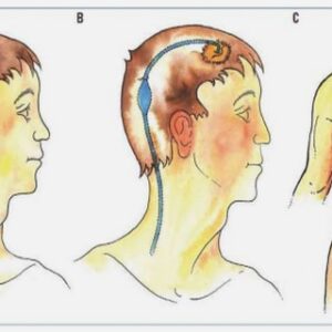 Les lésions cérébrales