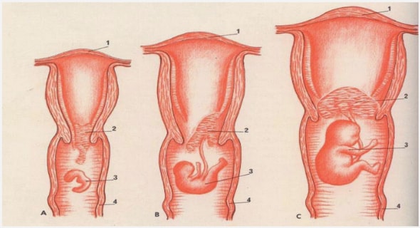 Particularités de l’hystérectomie obstétricale en période péri et postpartum