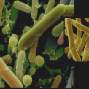 Les leucémies aigues lymphoblastiques de l’enfant