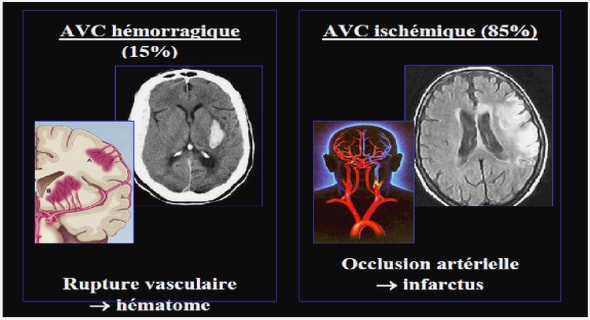 Les territoires cérébraux atteints par l’accident ischémique cérébral d’origine carotidienne